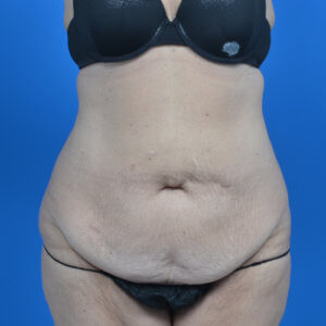 Tummy tuck before front 0719