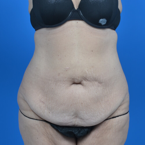 Tummy tuck before front 0719
