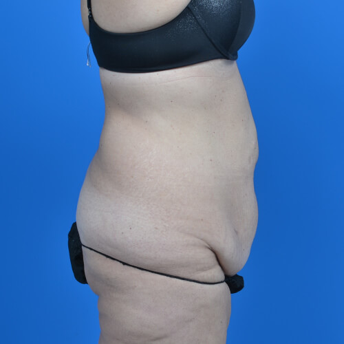 Tummy tuck before side 0719