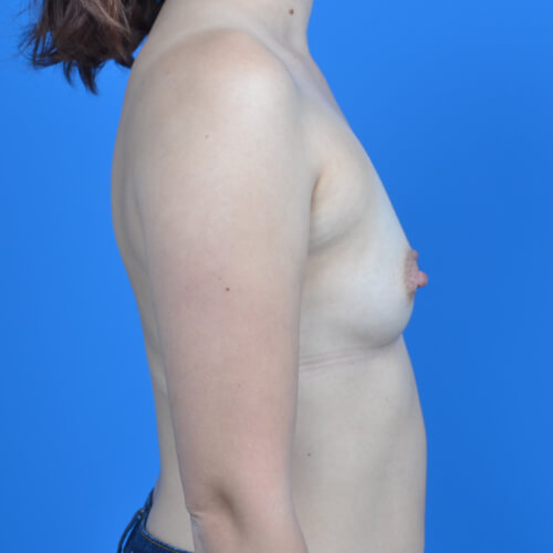 Breast augmentation before right side 325cc soft touch