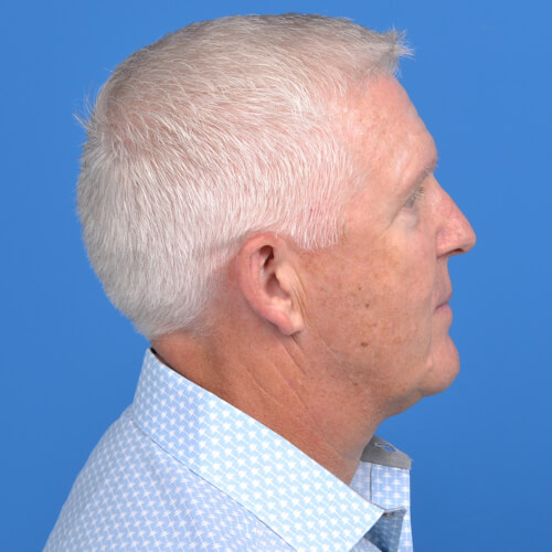 Male neck lift tz plasty after right side 1116