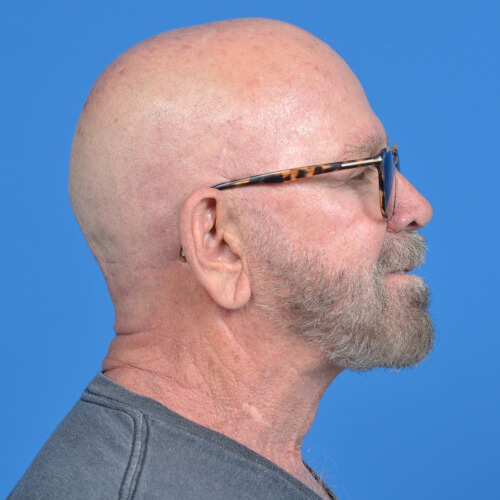 Neck lift after right side