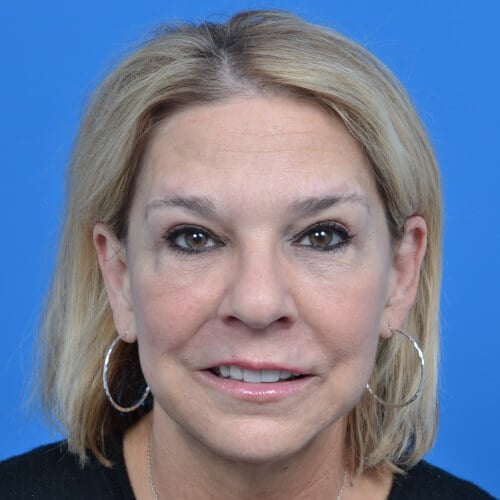 Upper eyelid blepharoplasty after front 1102