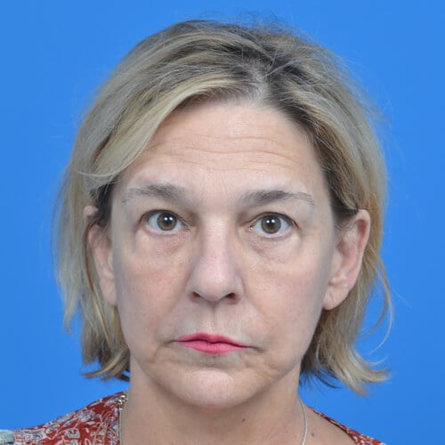 Upper eyelid blepharoplasty before front 1102