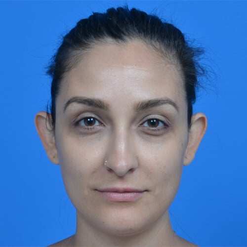 Otoplasty before front 1913