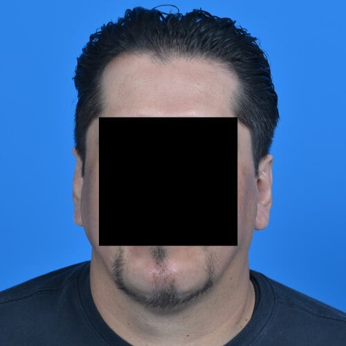 Otoplasty after front