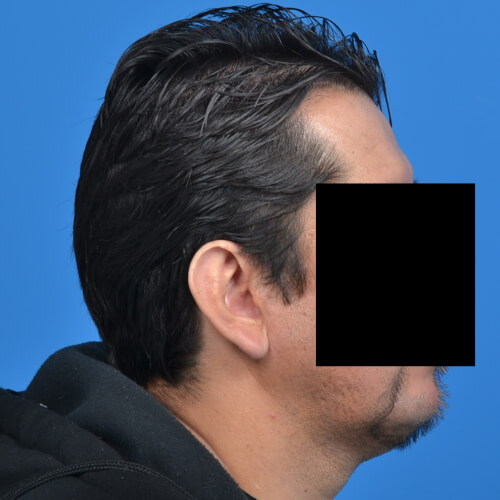 Otoplasty before right side