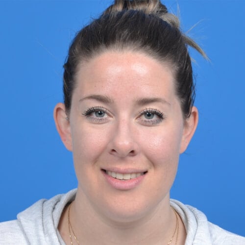 Otoplasty before front 1219