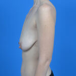 Breast lift with implant left side before