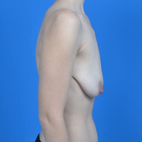Breast lift with implant right side before