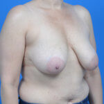 Breast lift mastopexy before right oblique