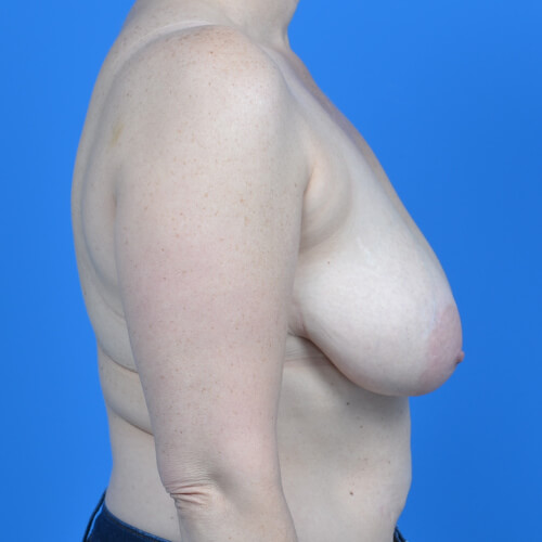 Breast lift mastopexy before right side