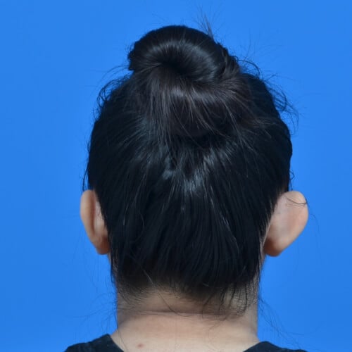 Otoplasty before back asymmetry