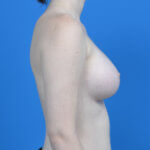 Breast augmentation 265ssf after right side