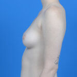 Breast augmentation 265ssf before left side
