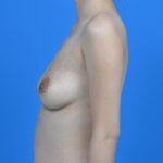 Breast augmentation natrelle 235cc low plus profile left side before
