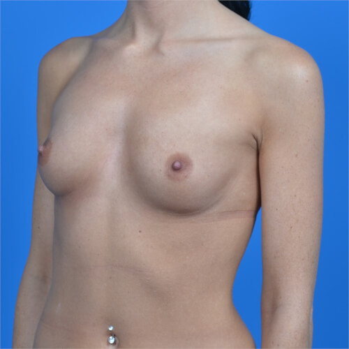Breast augmentation 310cc natrelle softtouch left oblique before