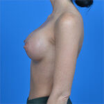 Breast augmentation 310cc natrelle softtouch left side after