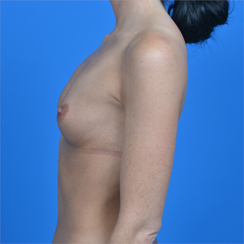 Breast augmentation 310cc natrelle softtouch left side before