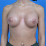Breast augmentation 310cc natrelle softtouch front after