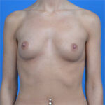 Breast augmentation 310cc natrelle softtouch front before