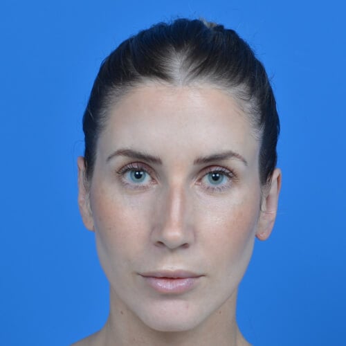 Otoplasty-after-front-1919