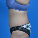 Tummy tuck after weight loss after left side