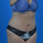 Tummy tuck after weight loss after right oblique