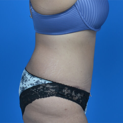 Tummy tuck after weight loss after right side