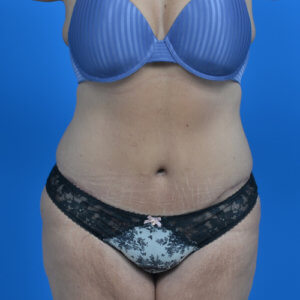 Tummy tuck after weight loss after front