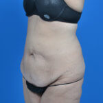 Tummy tuck after weight loss before left oblique