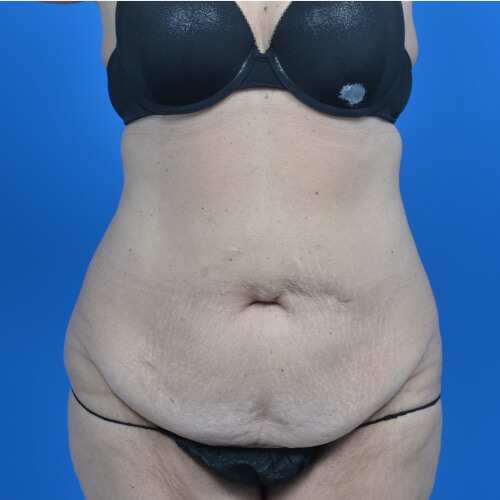 Tummy tuck after weight loss before front