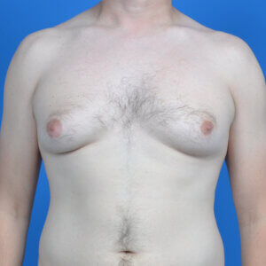Gynecomastia-safelipo-before-front