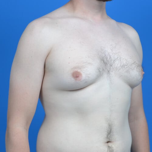 Gynecomastia-safelipo-before-ro