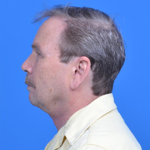 Male neck lift left side after