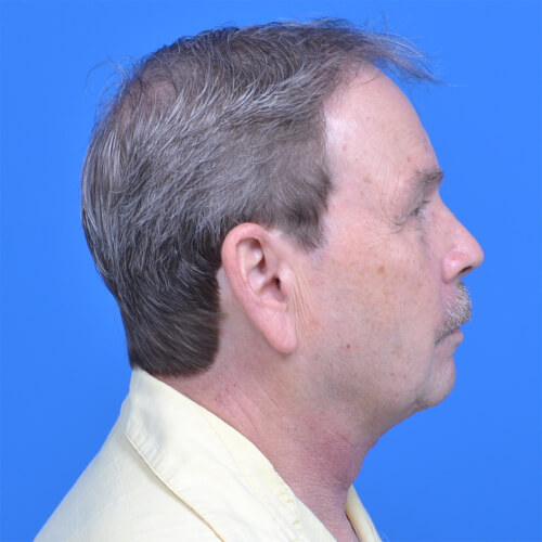 Male neck lift right side after