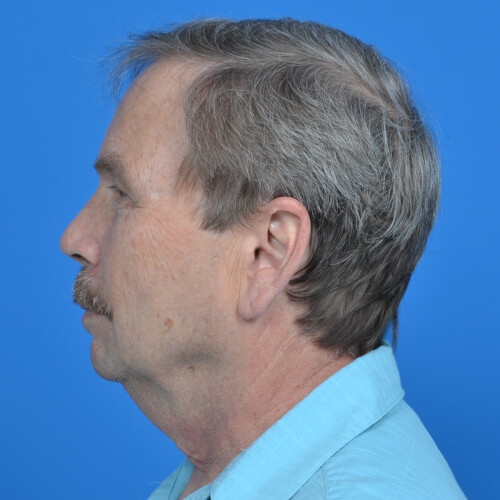 Male neck lift left side before