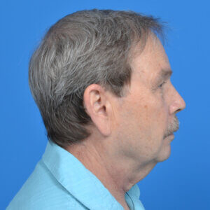 Male neck lift right side before