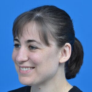 Otoplasty unilateral left oblique after