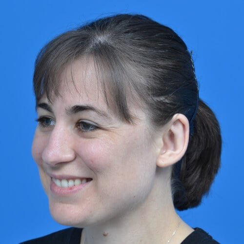 Otoplasty unilateral left oblique after