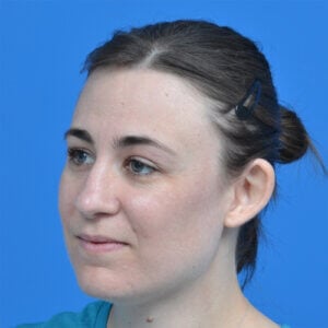 Otoplasty unilateral left oblique before