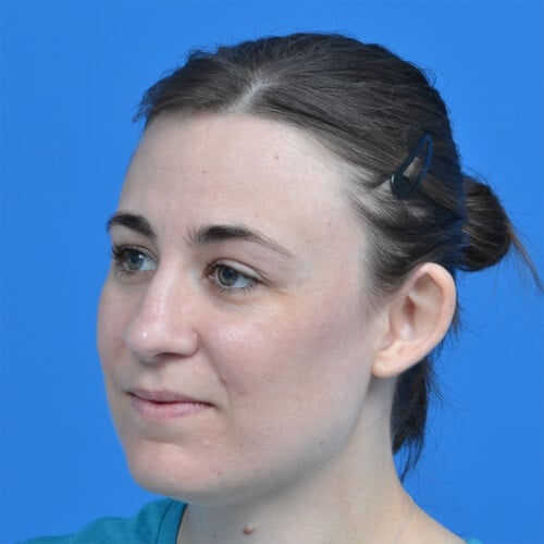 Otoplasty unilateral left oblique before