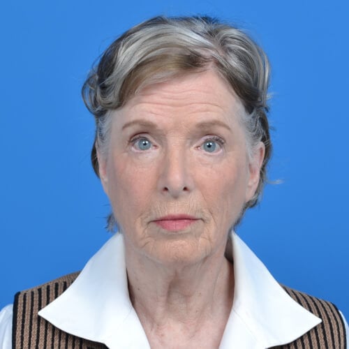 Facelift-before-front-0202