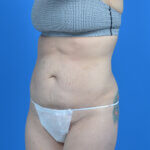 Tummy tuck after weight loss before left oblique