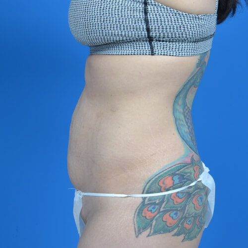 Tummy tuck after weight loss before left side