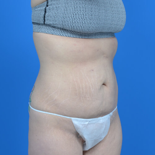 Tummy tuck after weight loss before right oblique