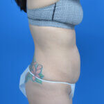 Tummy tuck after weight loss before right side