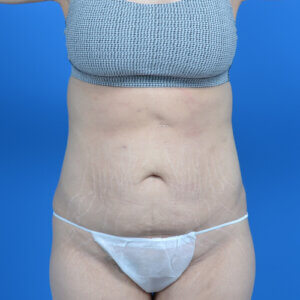 Tummy tuck after weight loss before front