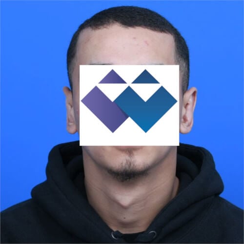 Otoplasty after front