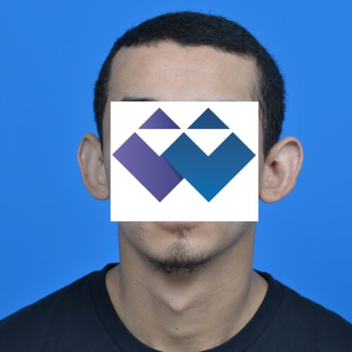 Otoplasty before front